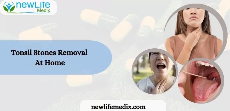 Tonsils Stones Removal At Home